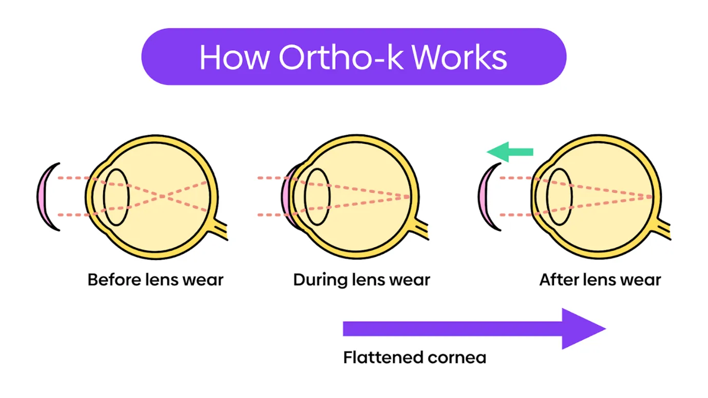 Diagram of how Ortho-K works: the eye before lens wear, during lens wear and after, with a flattened cornea